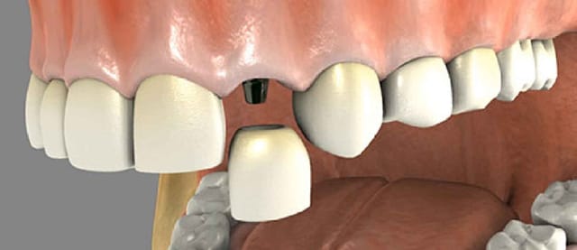 Dental Implants Dental Implant