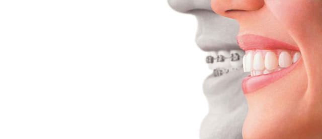 Invisalign Invisalign